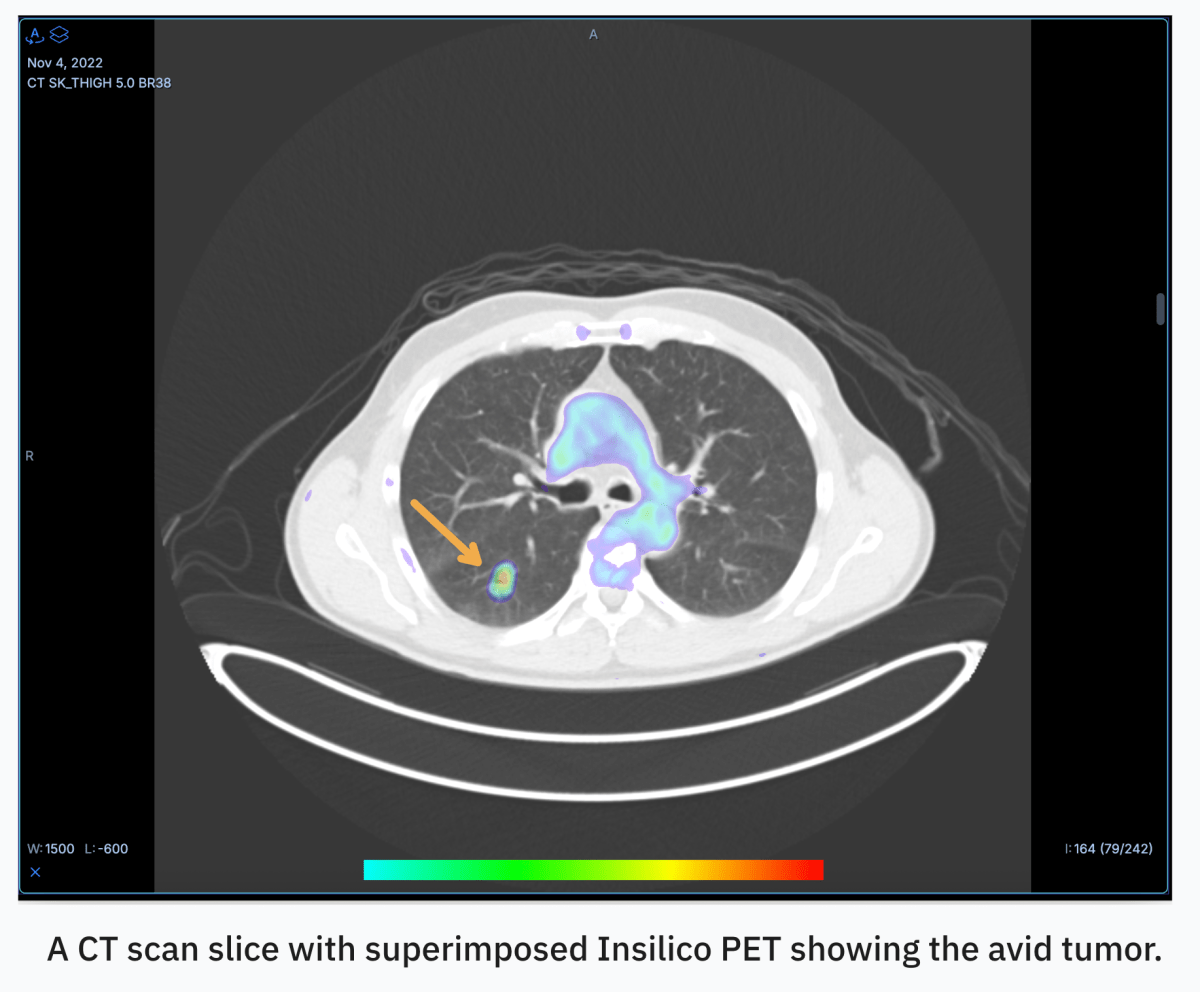 RADiCAIT AI Could Make Diagnostic PET Scans Obsolete